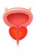 Entzündung der Prostata